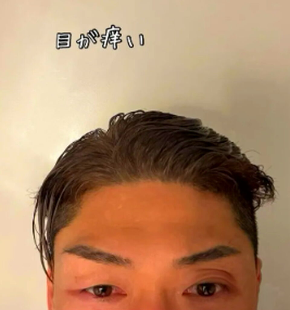 樽美酒研二 蕁麻疹 インスタグラム